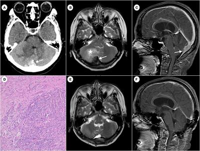 Case report: Intracranial lesions of cat-scratch disease mimicking an atypical meningioma